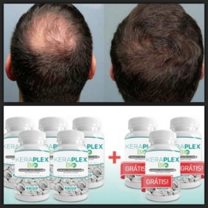 keraplex-para-calvicie