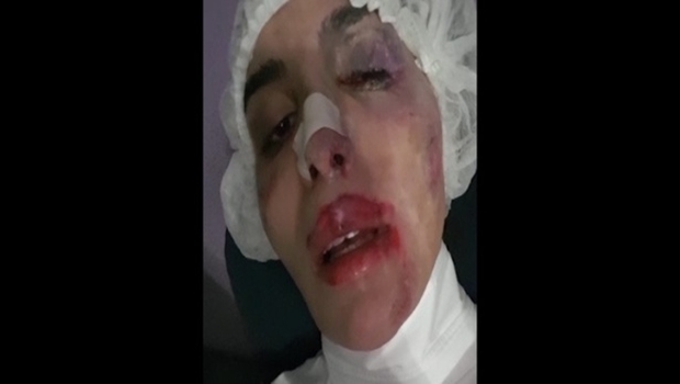 Imagens de Vivinay com o rosto desfigurado depois de agressão | Reprodução / Arquivo pessoal