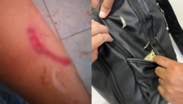 Mulher mostra braço e bolsa com sinais de golpes de faca | Foto: PC-GO