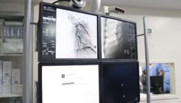 HGG angioplastia pulmonar