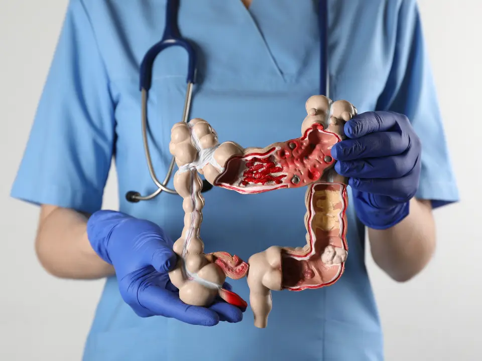 Cancer-de-intestino-960x720-1
