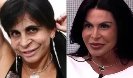 medico-mostra-o-antes-e-depois-de-gretchen-apos-procedimentos-esteticos-1759586691780_v2_900x506-jpg