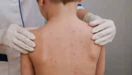 crianc-a-meningite-meningoco-cica