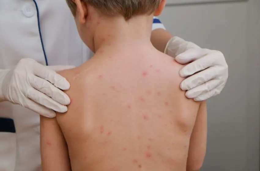 crianc-a-meningite-meningoco-cica