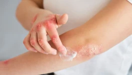 Psoriase_consenso