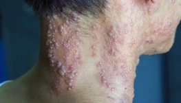 herpes-zoster-foto-capa-1200x676