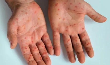 como-se-pega-mpox-entenda-as-formas-de-transmissao-do-virus-594