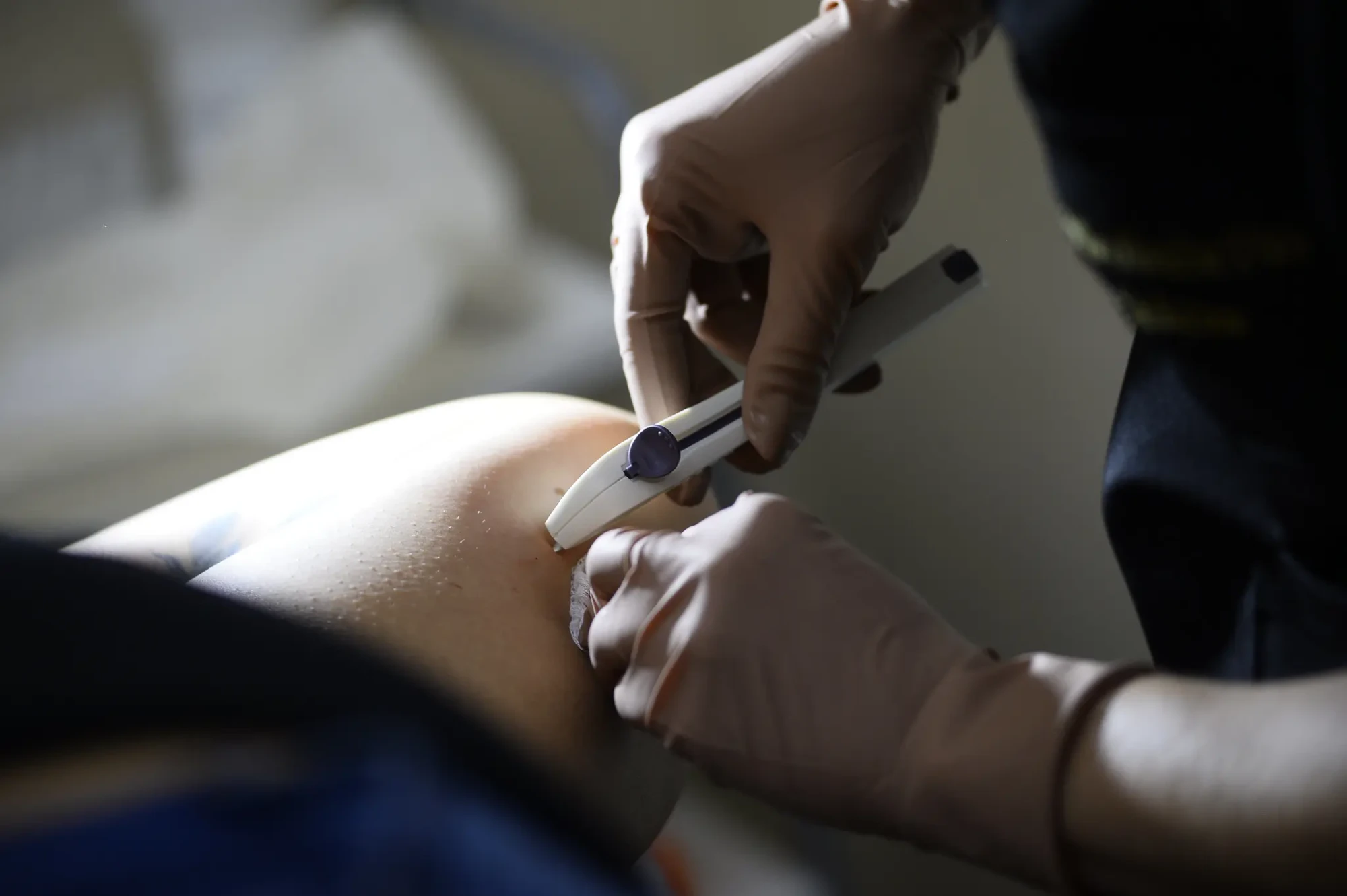 Implanon no SUS em Goiás: saiba como funciona, como é aplicado e confira respostas para as principais dúvidas