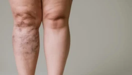 lipedema-e-varizes-1024x683