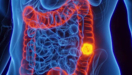 Sinais-e-sintomas-do-Cancer-Colorretal-1024x536