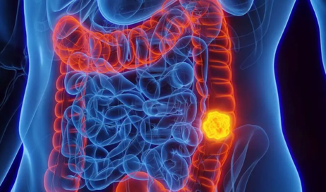 Sinais-e-sintomas-do-Cancer-Colorretal-1024x536