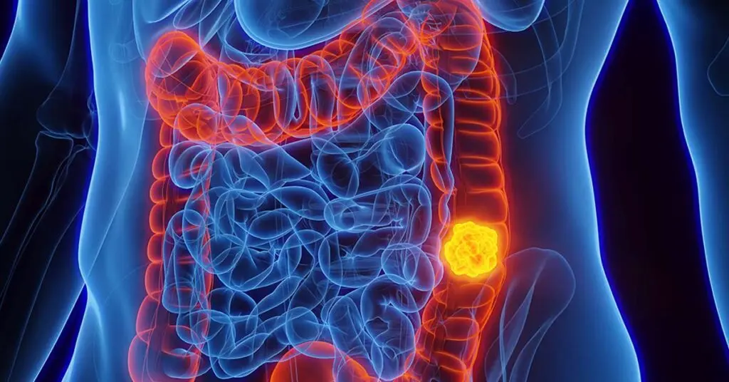 Sinais-e-sintomas-do-Cancer-Colorretal-1024x536