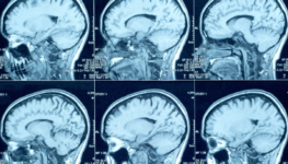 creutzfeldt-jakob-e-uma-condicao-neurologica-rara-que-provoca-degeneracao-progressiva-do-cerebro-3389328-article