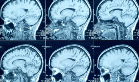 creutzfeldt-jakob-e-uma-condicao-neurologica-rara-que-provoca-degeneracao-progressiva-do-cerebro-3389328-article