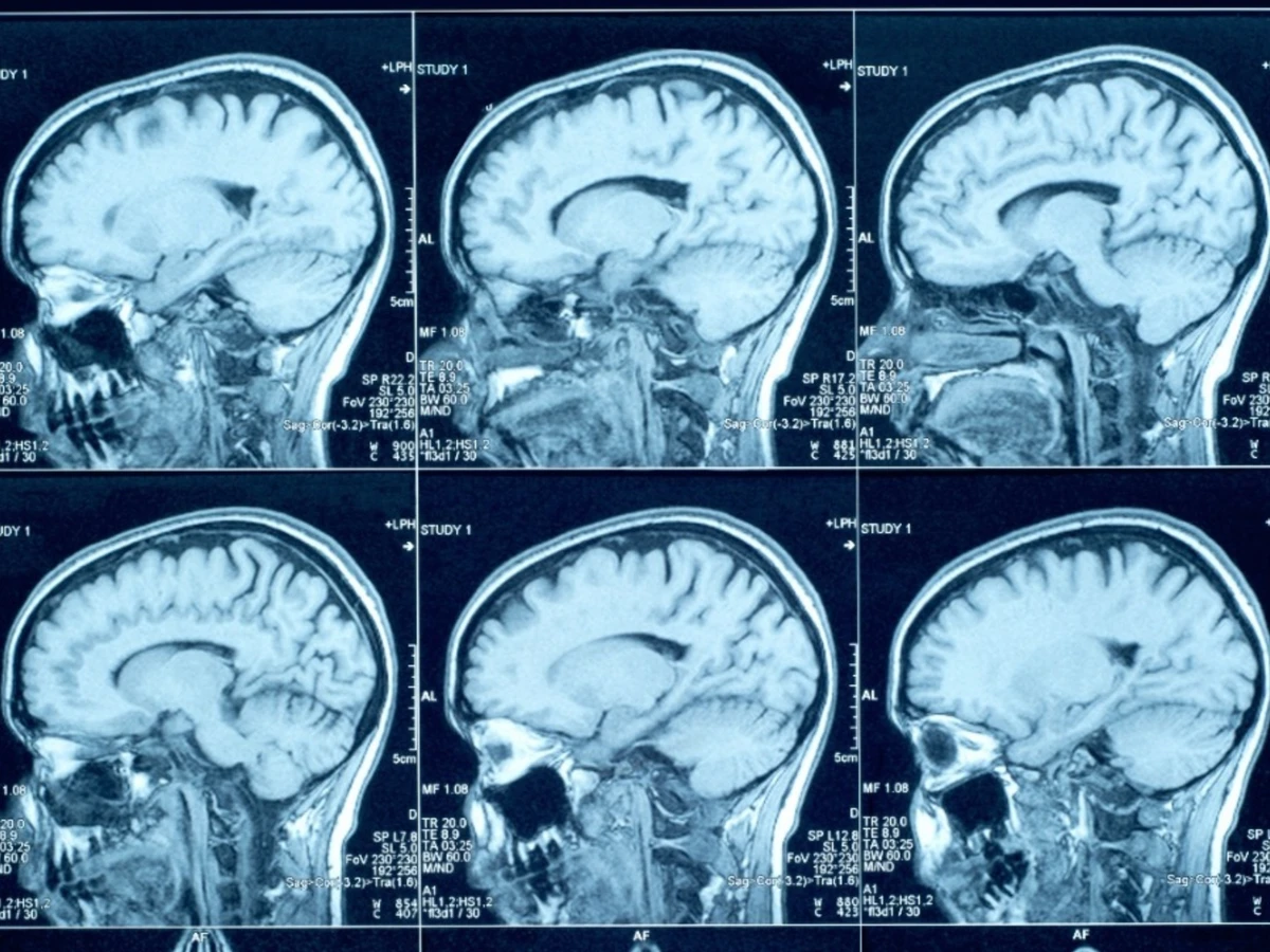 creutzfeldt-jakob-e-uma-condicao-neurologica-rara-que-provoca-degeneracao-progressiva-do-cerebro-3389328-article