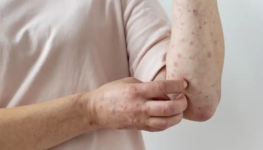 alergia-cutanea-no-braco-de-uma-pessoa