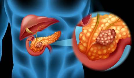 cancer-no-pancreas-1b
